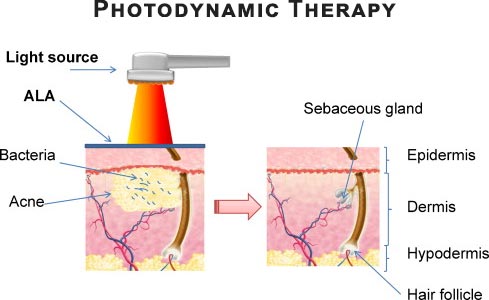 APD Professional Photodynamic LED Therapy